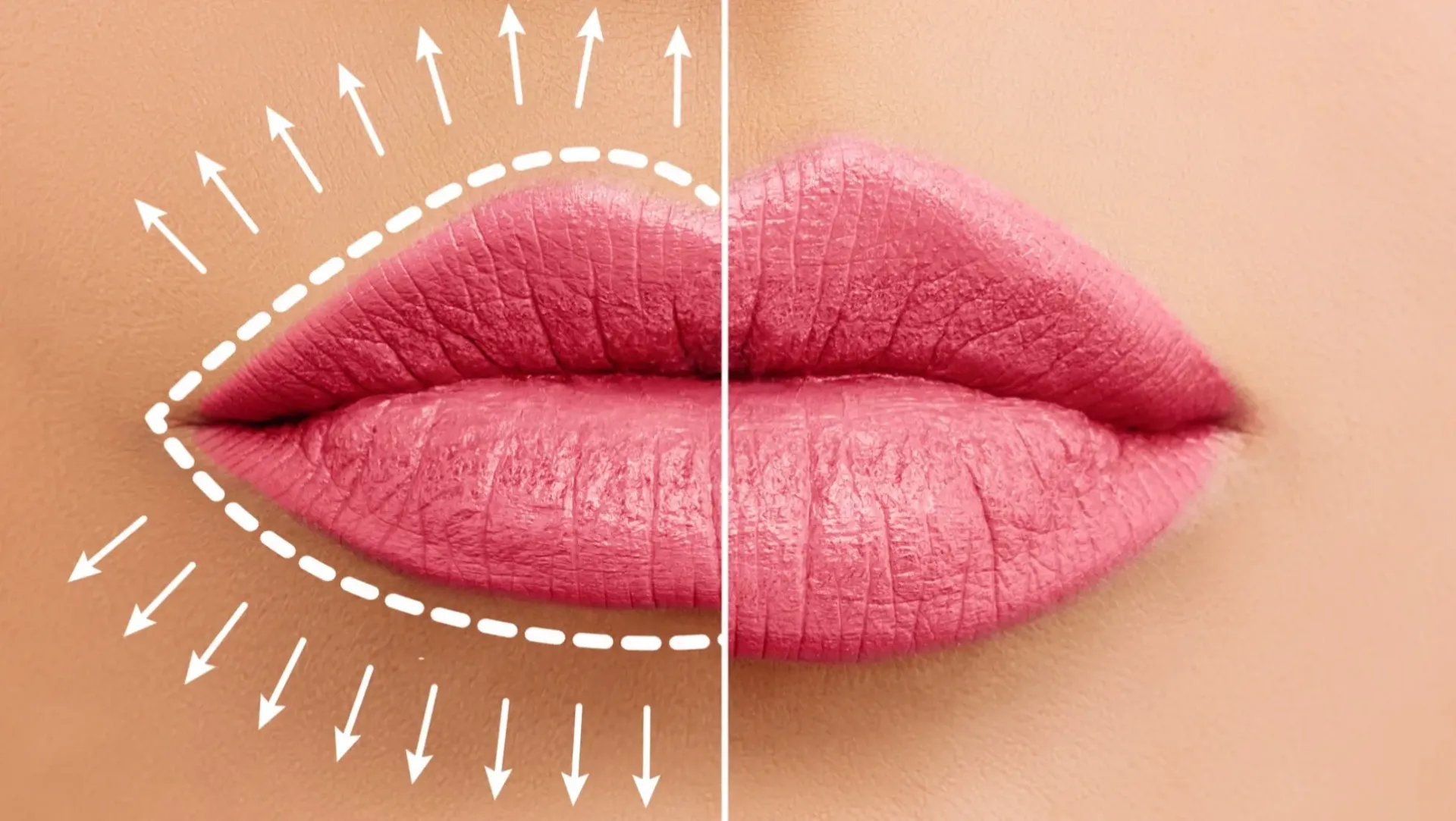 Контурная пластика губ